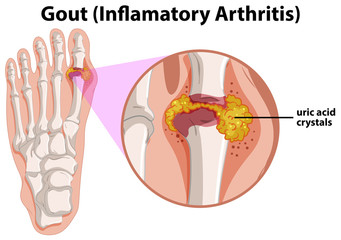 Gouty Arthritis